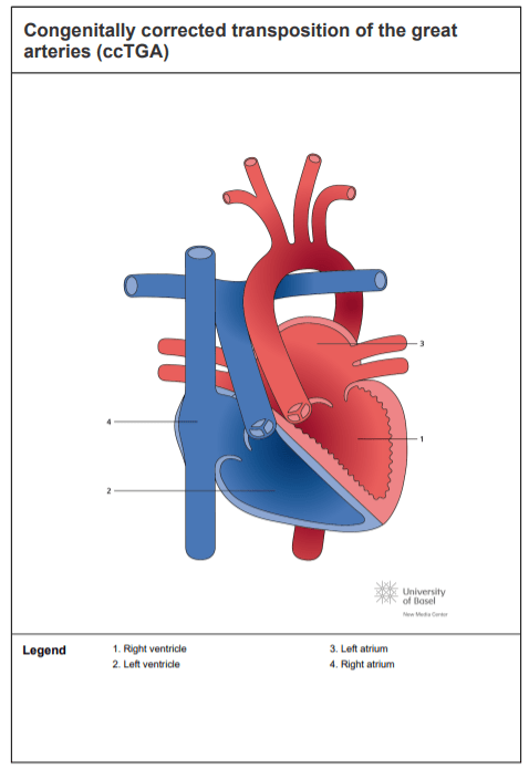 Systemic right ventricle are found